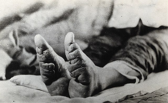 Feet of a Chinese woman, showing the effect of foot-binding
